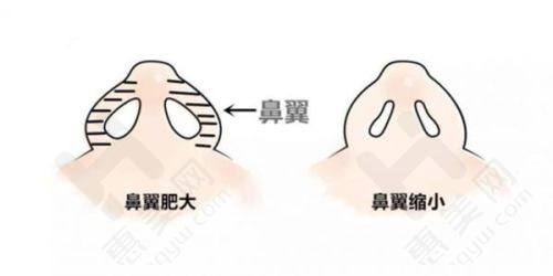 网友评价范荣杰医生隆鼻技术