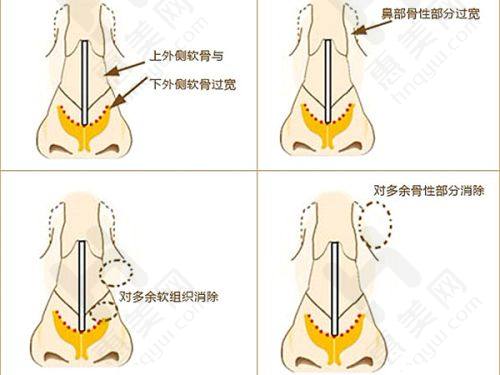 范荣杰医生肋骨鼻综合实例