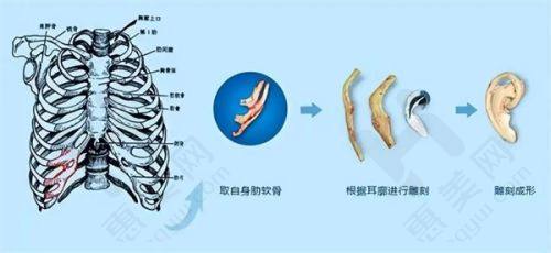 国内耳再造手术谁做得好