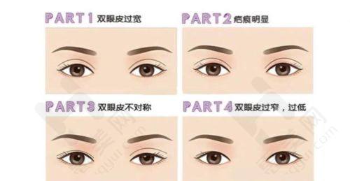 大连爱德丽格王鹤霏双眼皮修复优势
