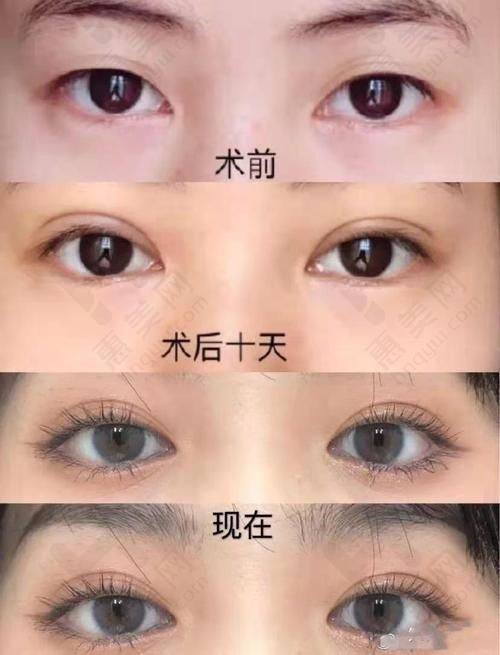 大连爱德丽格王鹤霏双眼皮手术实例