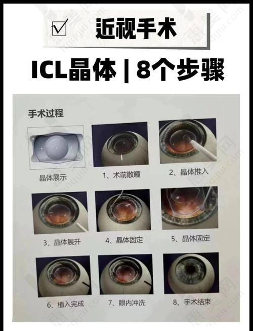上海新视界晶体植入推荐：正规可靠的选择