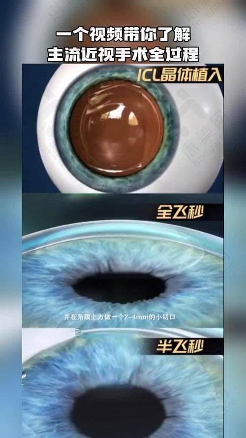 上海和平眼科晶体植入推荐：专精团队保护成效