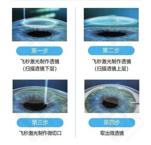 2025年爱尔眼科各项手术费用对比分析