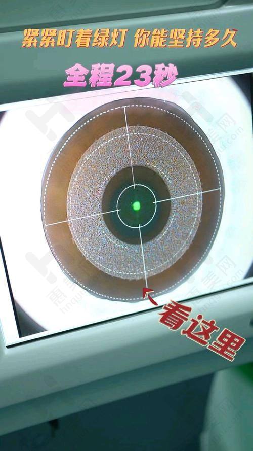 乔利亚和齐越兜带式后巩膜加固术对重度高度近视的治疗成效