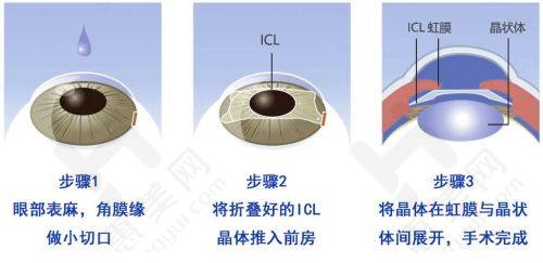 北京华德眼科医院口碑评价怎么样