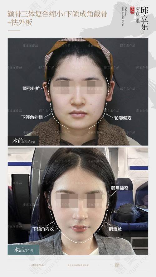 莆田颧骨颧弓医院排名前十有哪些,排名靠前医院医生技术咋样,排名依据、价格及口碑情况全知晓
