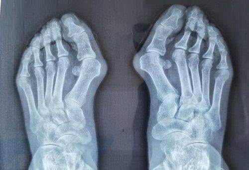 影响长春激光祛眼袋价格的因素