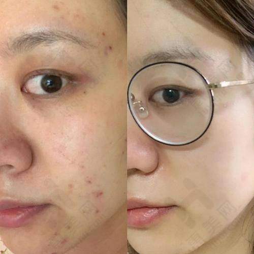不同科室光子嫩肤价格对比