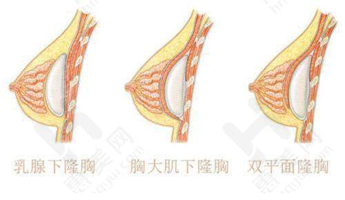 许昌博爱医院割双眼皮相关探讨