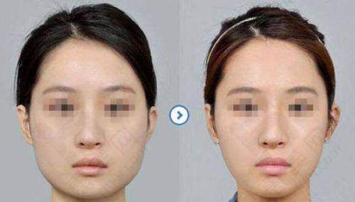 特色项目之自体脂肪面部填充