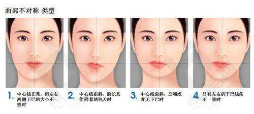 黄烨华医生鼻整形实例