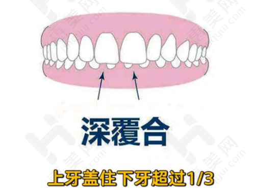 正畸皮筋具体挂法及工具使用