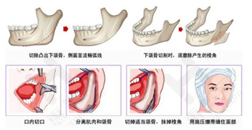 西安瑞诺双眼皮修复情况