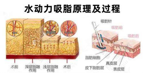 西安瑞诺吸脂瘦腰情况