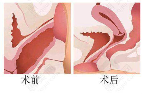 西安俪时代张永医生双燕尾提升术价格