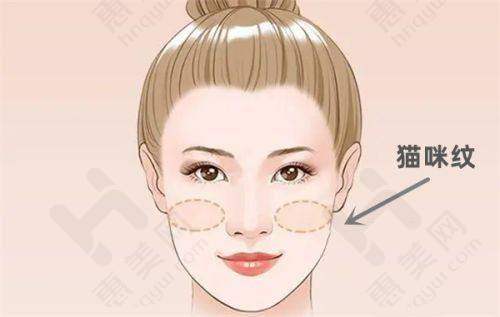 双眼皮修复优势