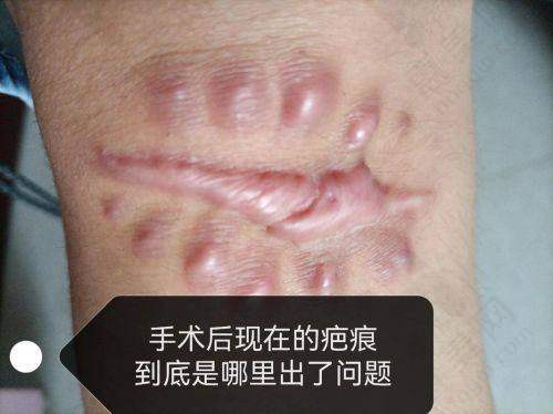 贵阳华医医院疤痕专科特色项目