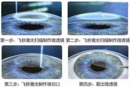 聊城爱尔眼科医院近视手术技术及优势
