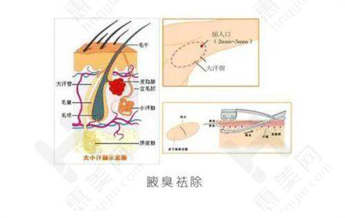 割双眼皮的优势