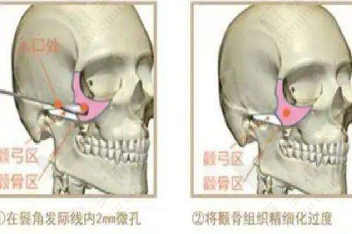 临沂光子嫩肤消费决策建议