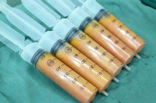 深圳阳光整形医院超皮秒优势多