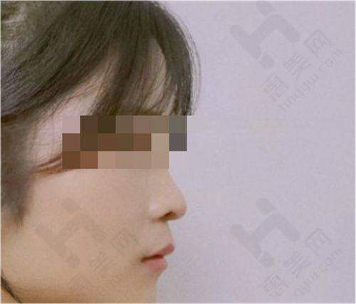 正规医院光子嫩肤价格体系