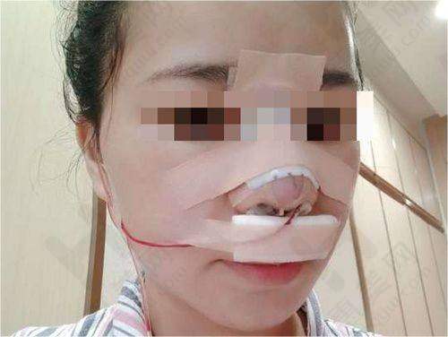 湘潭中 心医院光子嫩肤价格