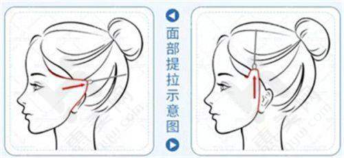正规医院光子嫩肤价目表