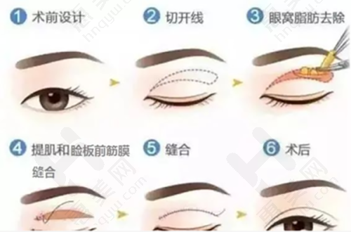 影响临沂光子嫩肤价格的因素