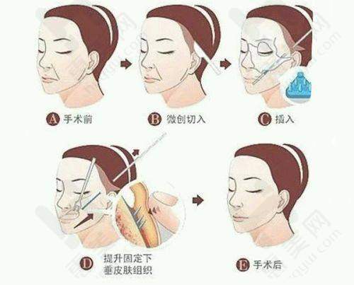舟山艾美医疗美容疤痕针价格相关