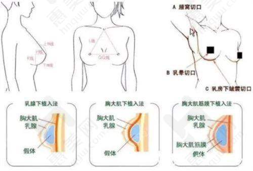鼻骨内推费用影响因素