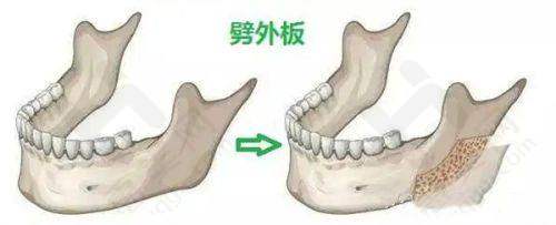 筋膜提升术价格分析
