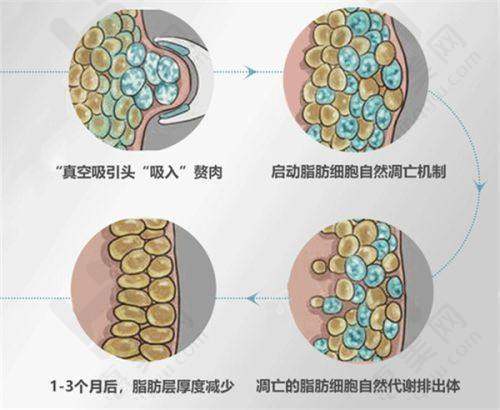 韩国美迪塑线提升提升项目优势