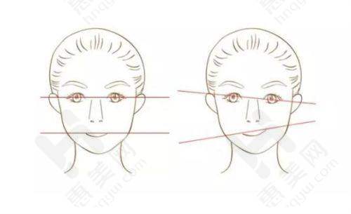 提眉术显著成效