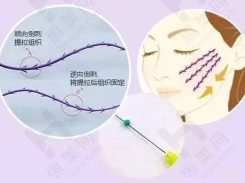 注射 BOTOX - 瘦脸针的注意事项之成效维持
