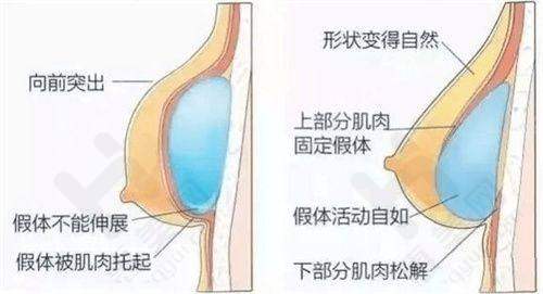 隆胸的技术理念