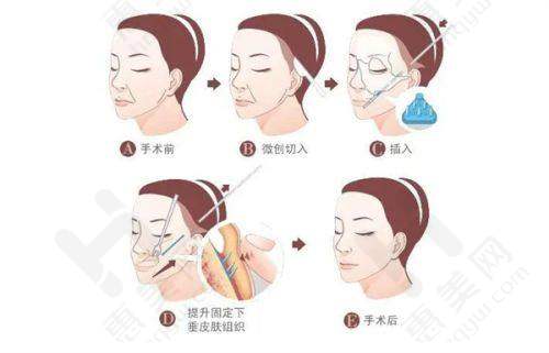 眼部整形技术出色