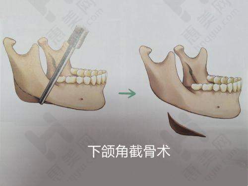 高难度鼻修复实例出色