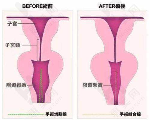 隆胸技术优势明显