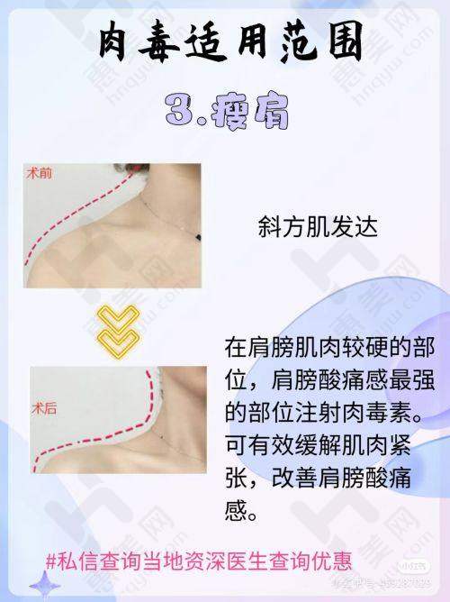 燕尾榫3D复刻隆鼻技术独特