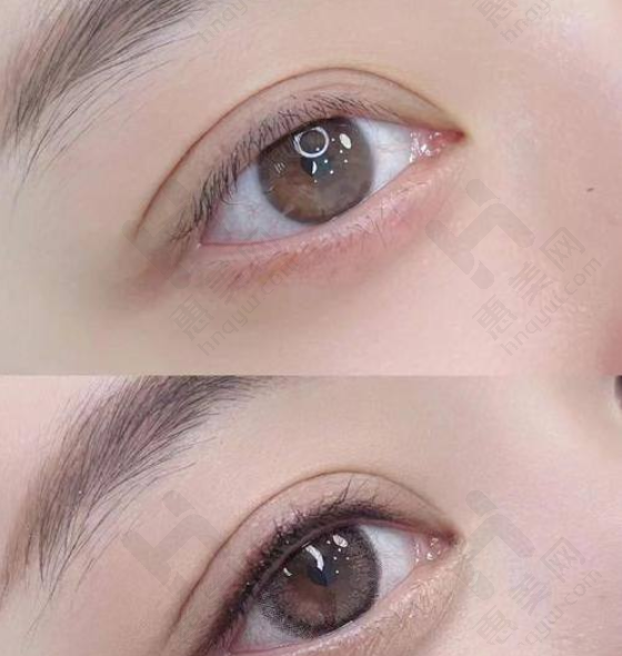膨体 + 肋软骨鼻综合隆鼻价格合理