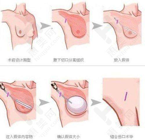 打水光针选择要点