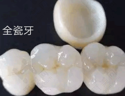 全口固定假牙优势明显
