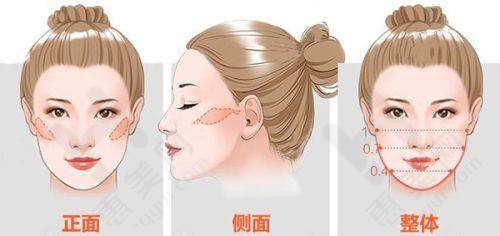 特色项目之李晓东pst面部提升