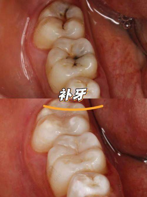 全口假牙材料多样可选