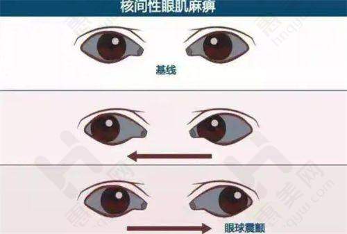 近视手术价格多样