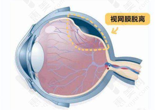 近视手术价格差异对比