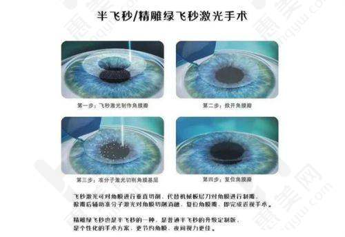 浙二眼科报销情况
