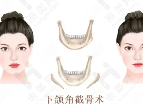 汪灏院长微痛丰胸价格合理